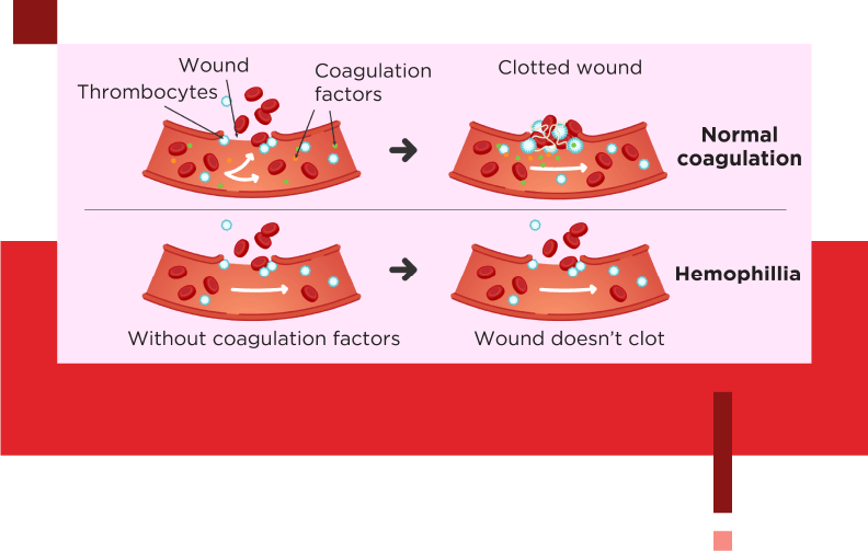 Takeda's mission towards raising hemophilia awareness globally